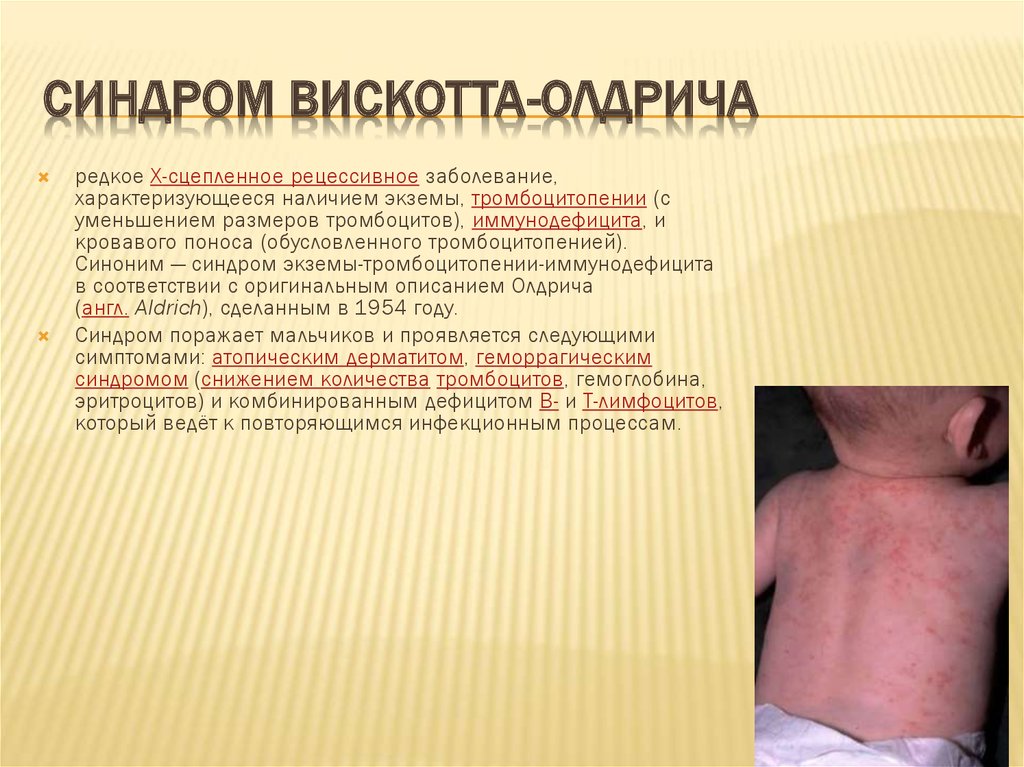 Синдром Вискотта-Олдрича