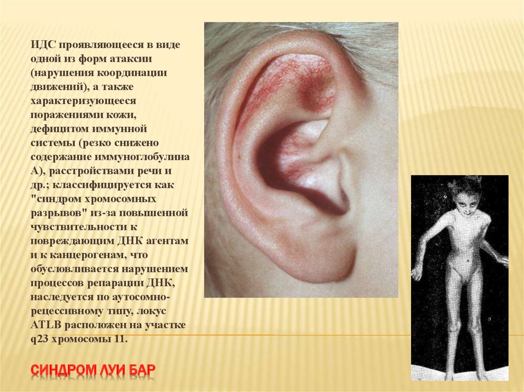 Синдром Луи Бар