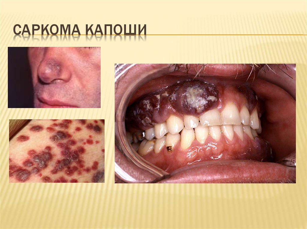 Саркома Капоши