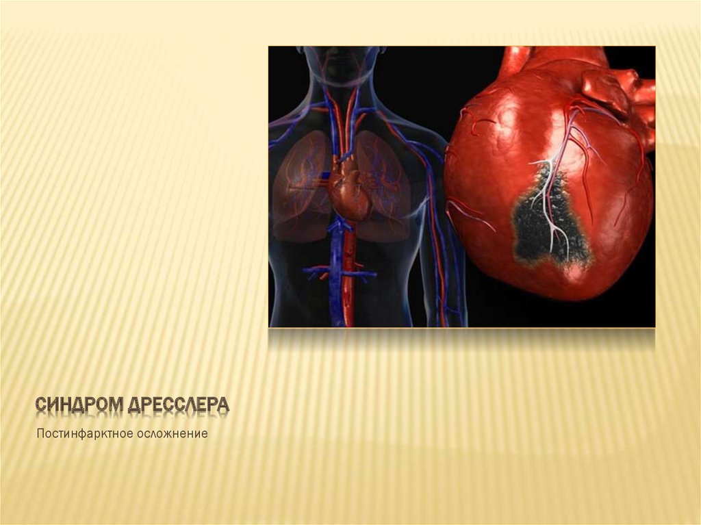 СИНДРОМ ДРЕССЛЕРА