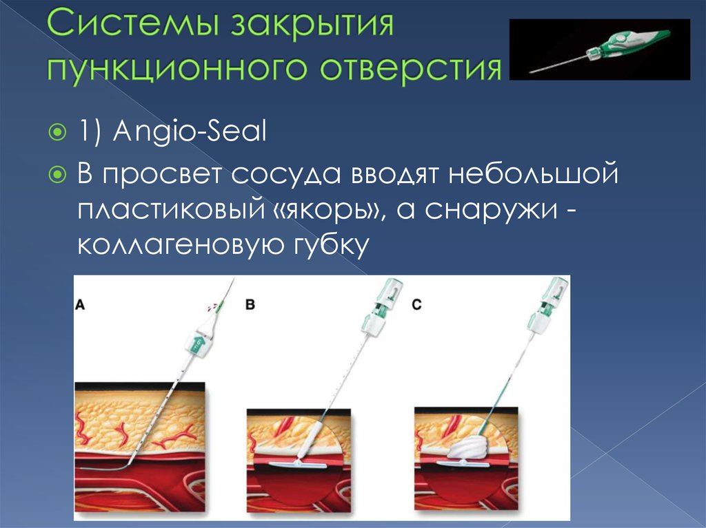 Система закрыть. Операции ликвидирующие просвет сосуда. Стент Angio-Seal.