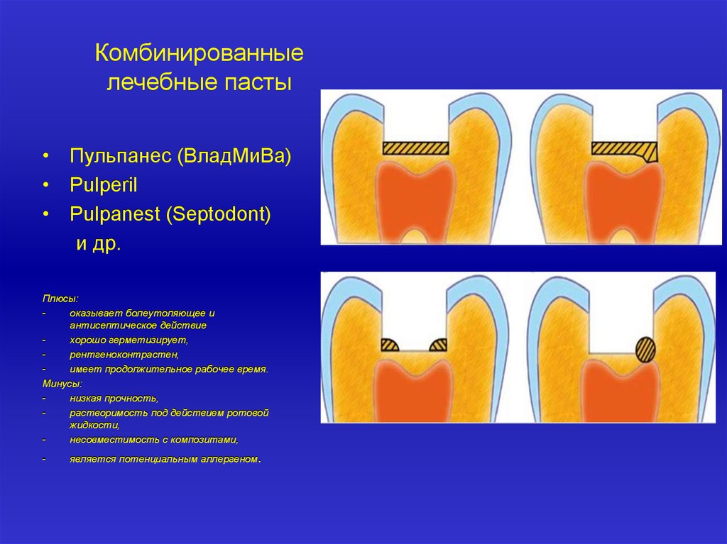 Схема наложения лечебных прокладок