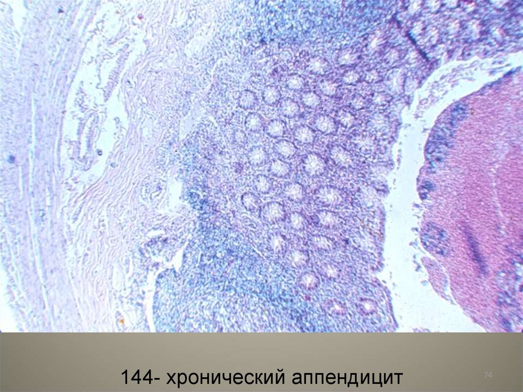 Флегмонозно язвенный аппендицит