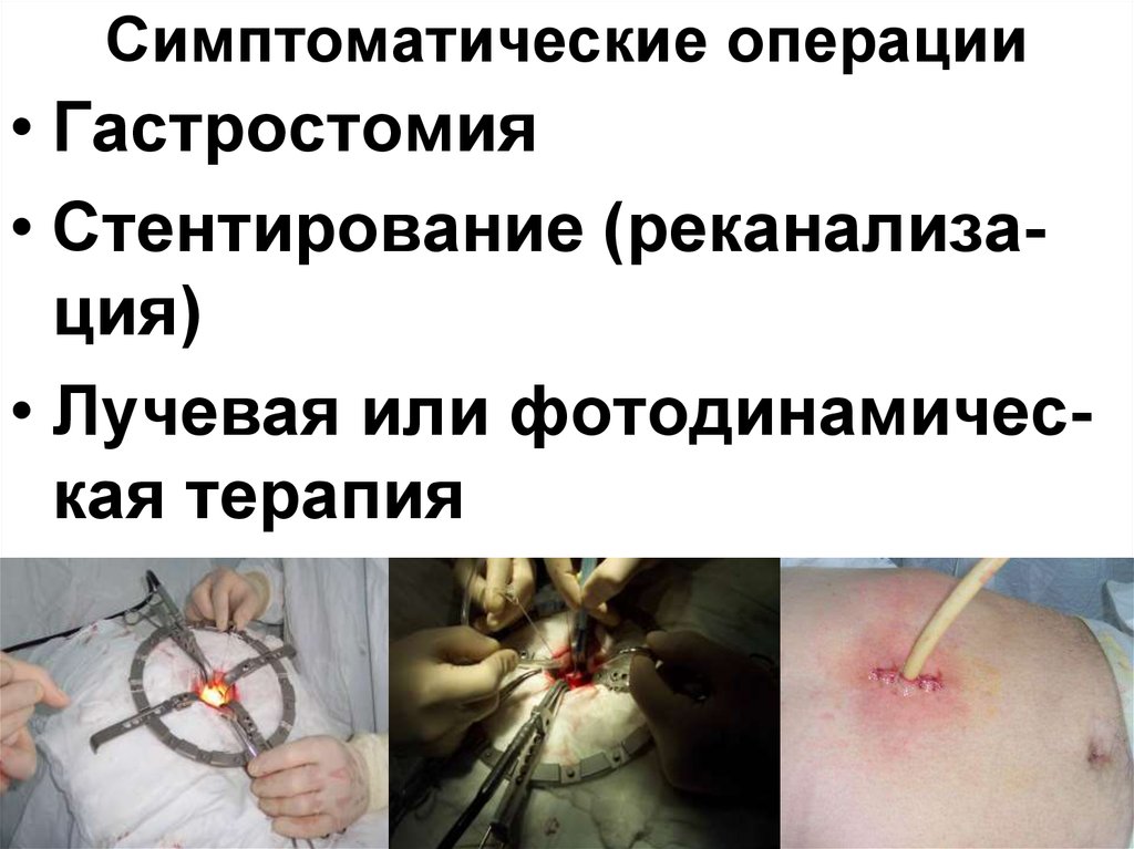 Симптоматические операции