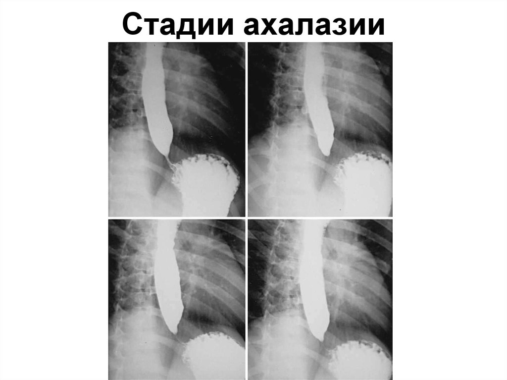 Рентгенологическая картина ахалазии пищевода при контрастировании