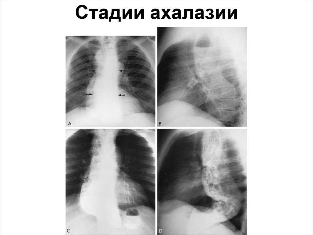 Стадии ахалазии