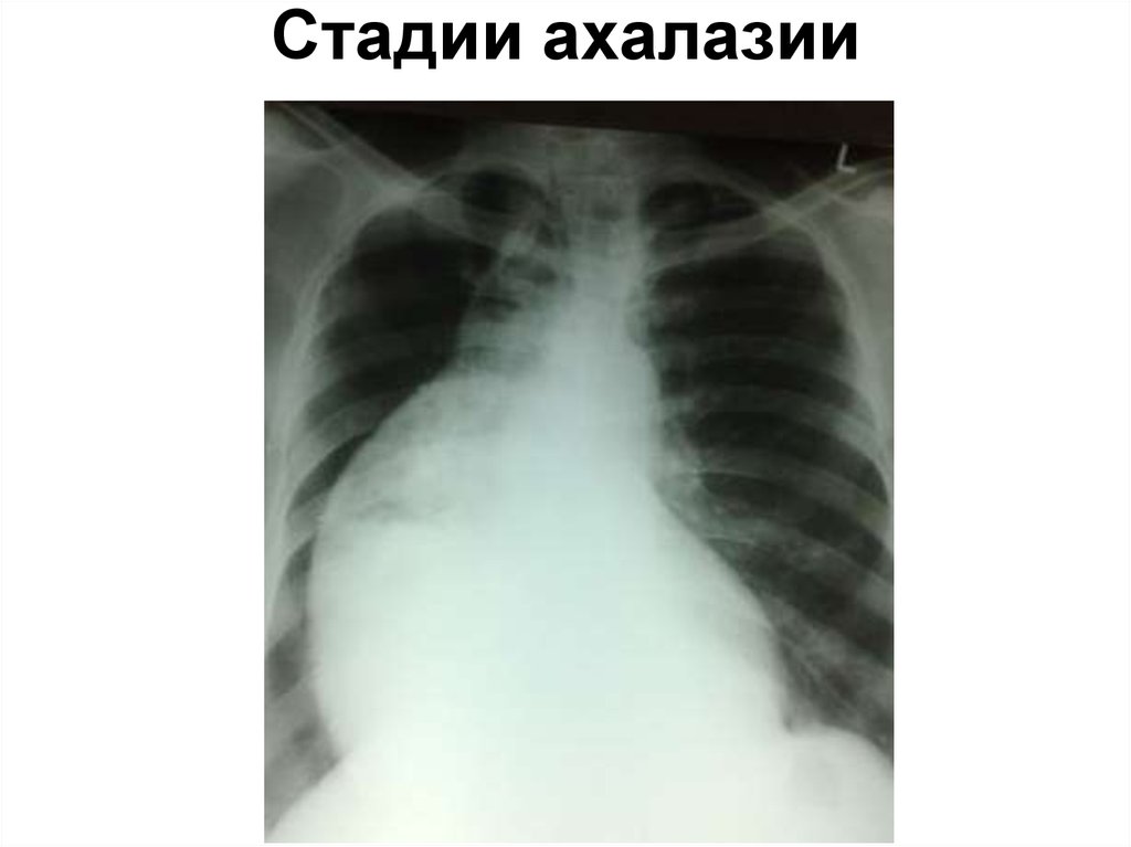 Стадии ахалазии