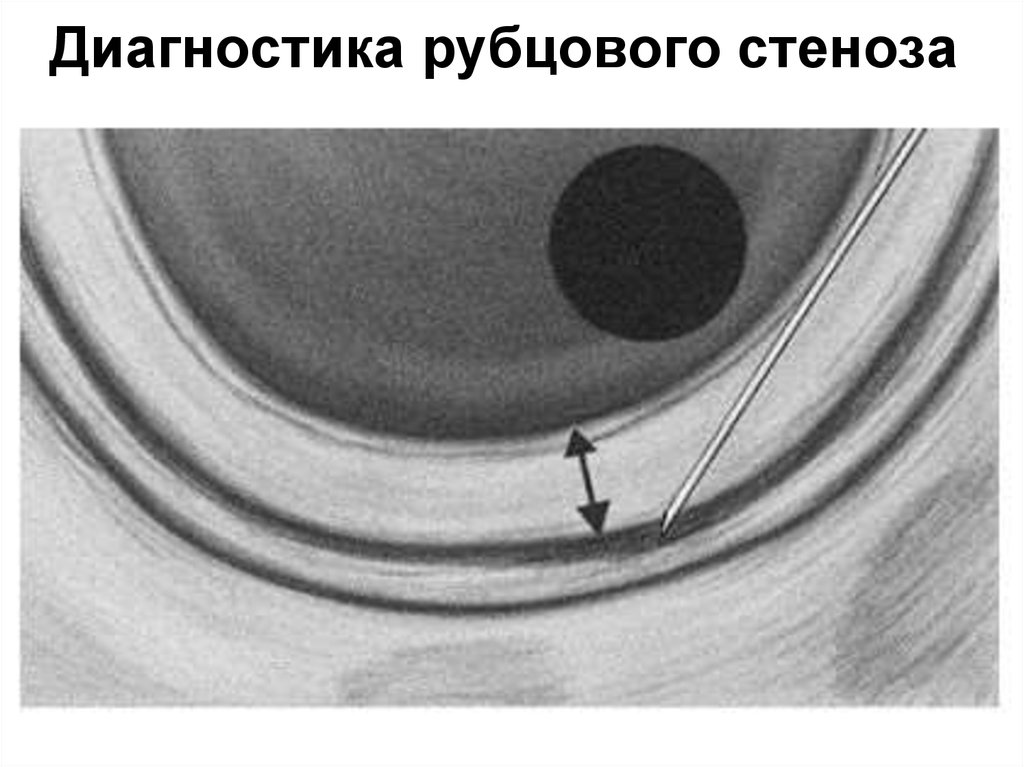 Диагностика рубцового стеноза