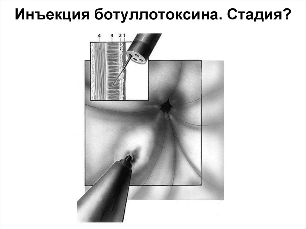 Инъекция ботуллотоксина. Стадия?