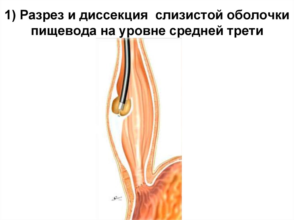 Травмы пищевода презентация