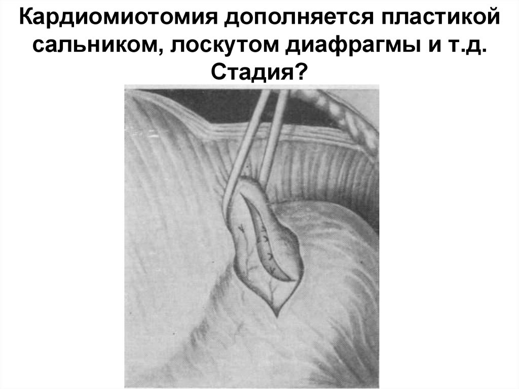Кардиомиотомия дополняется пластикой сальником, лоскутом диафрагмы и т.д. Стадия?