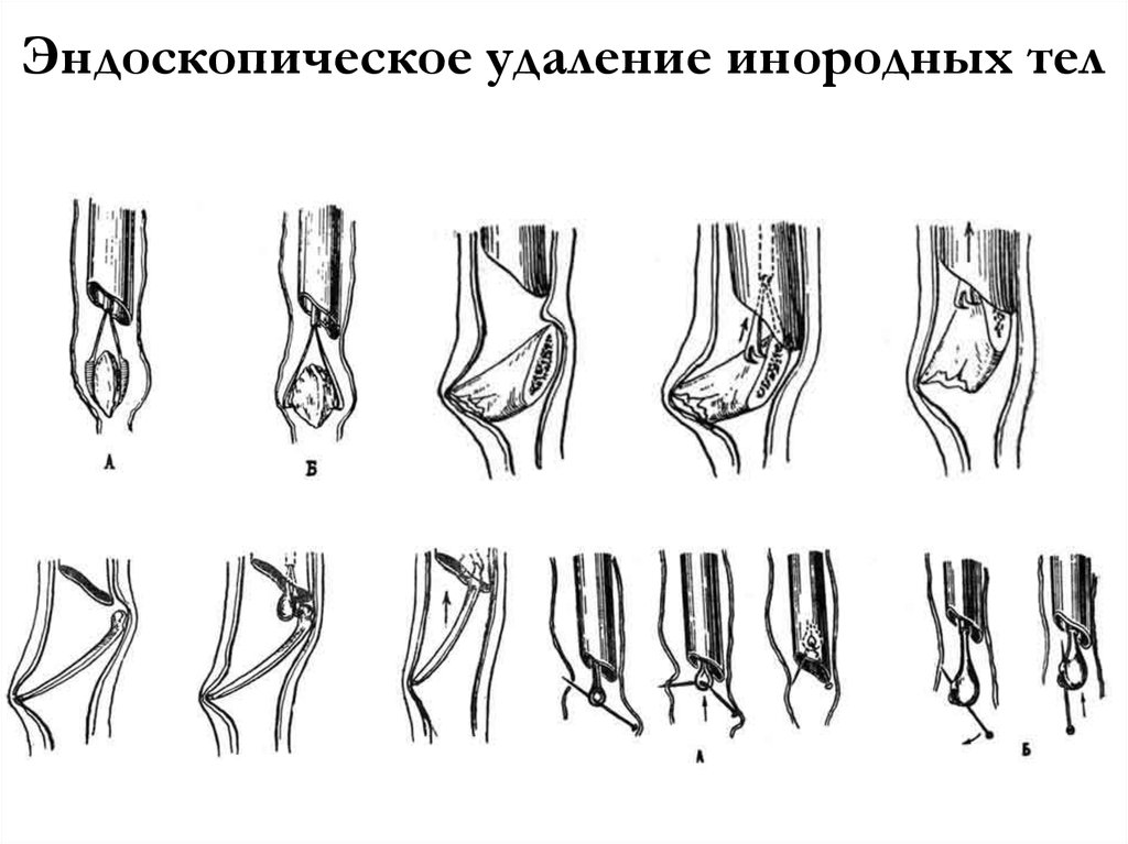 Удаление инородного тела. Эндоскопическое извлечение инородного тела. Удаление инородного тела пищевода.