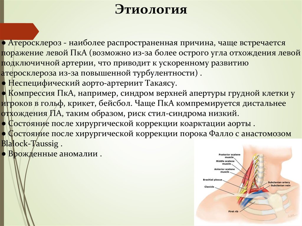 Синдром верхней апертуры грудной клетки