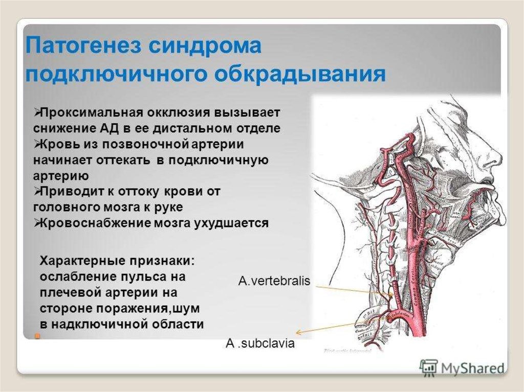 Стеноз подключичной. Стеноз подключичной артерии УЗИ. Стеноз подключичной артерии синдром. Окклюзия левой подключичной артерии. Окклюзия подключичной артерии.