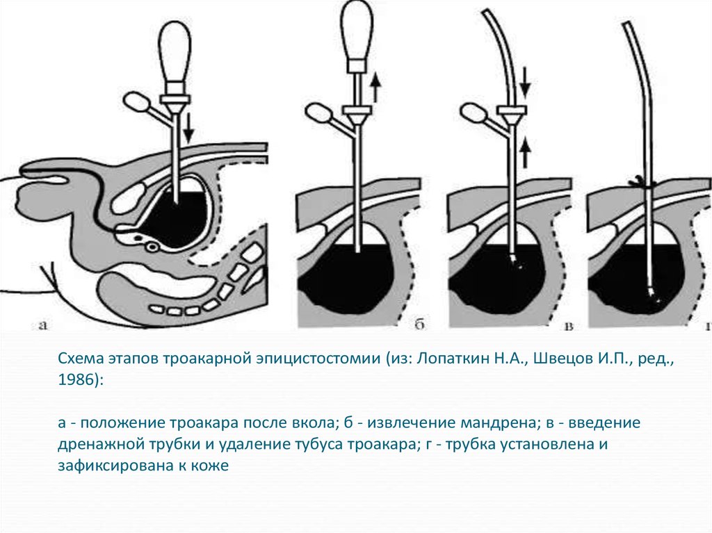 Цистотомия мочевого пузыря. Троакарная цистостомия техника операции. Цистостомия мочевого пузыря техника. Цистостома троакарная. Троакарная цистостомия ход операции.