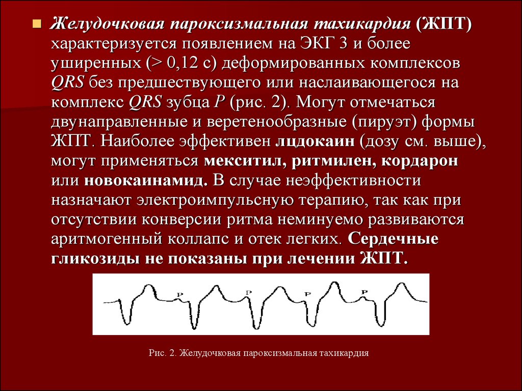 Пароксизмальная тахикардия. Пароксизмальная желудочковая тахикардия на ЭКГ. Вентрикулярная пароксизмальная тахикардия ЭКГ. Пароксизм желудочковой тахикардии ЭКГ. ЭКГ при желудочковой тахикардии.