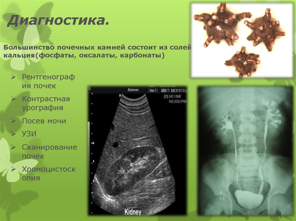 Оксалатовый камень в почке