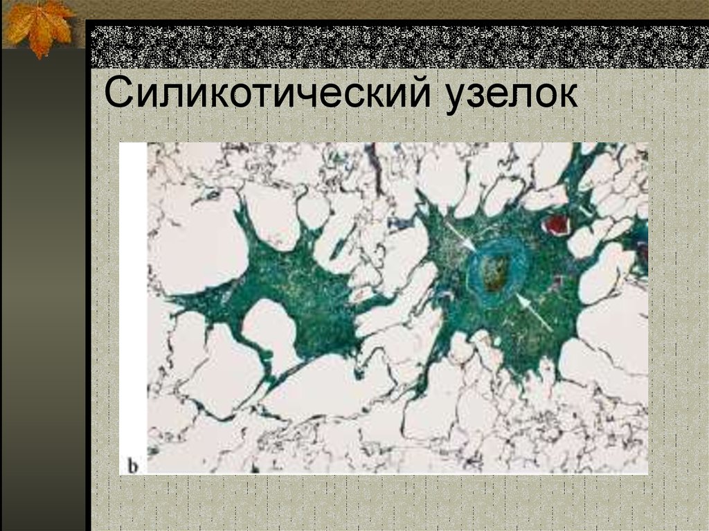 Силикоз легкого микропрепарат рисунок