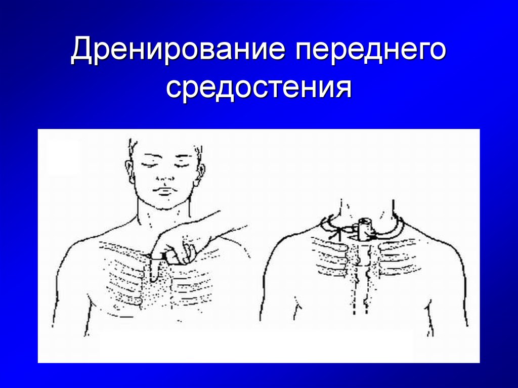 Дренирование. Дренирование средостения. Дренирование переднего средостения. Дренирование средостения при медиастините. Способы дренирования переднего средостения.