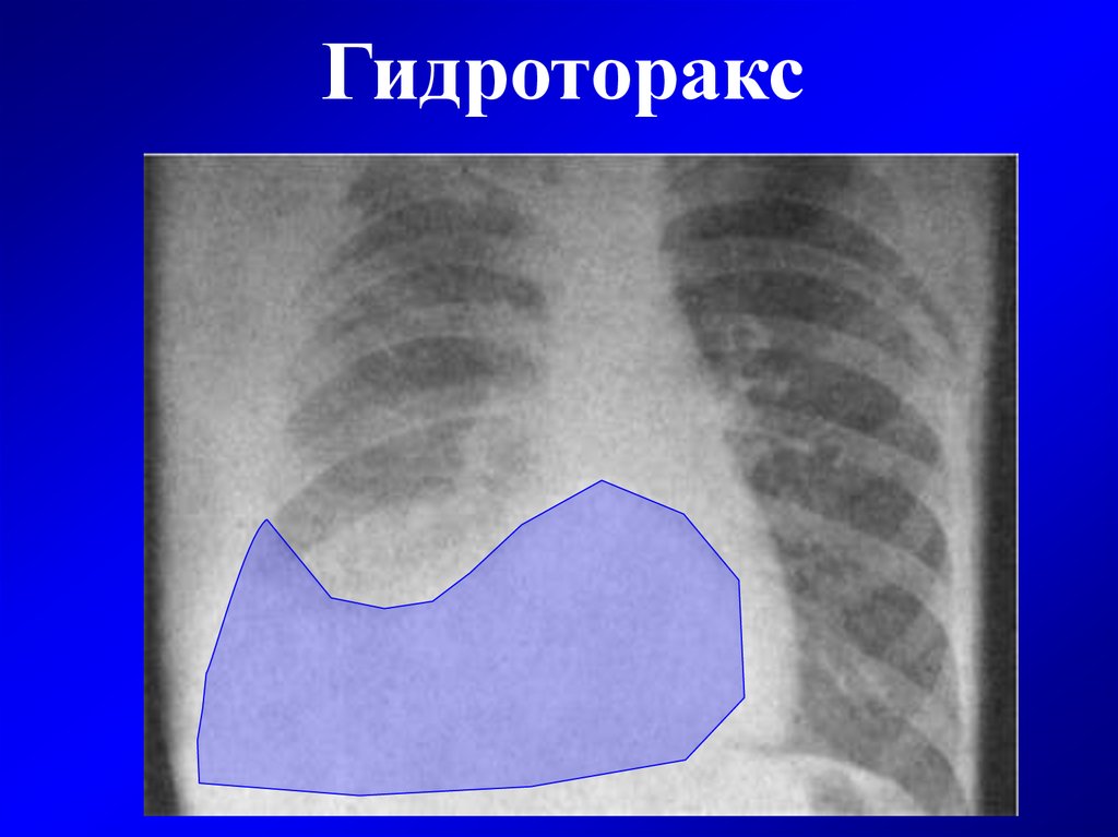 Что такое гидроторакс. Правосторонний малый гидроторакс. Гидроторакс грудная клетка. Гидроторакс перкуторно.