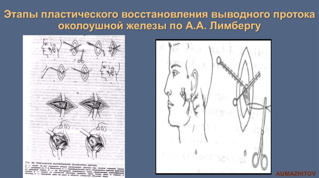 Околоушная железа операция