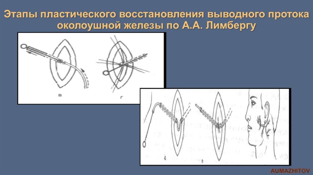 Этапы пластического восстановления выводного протока околоушной железы по А.А. Лимбергу