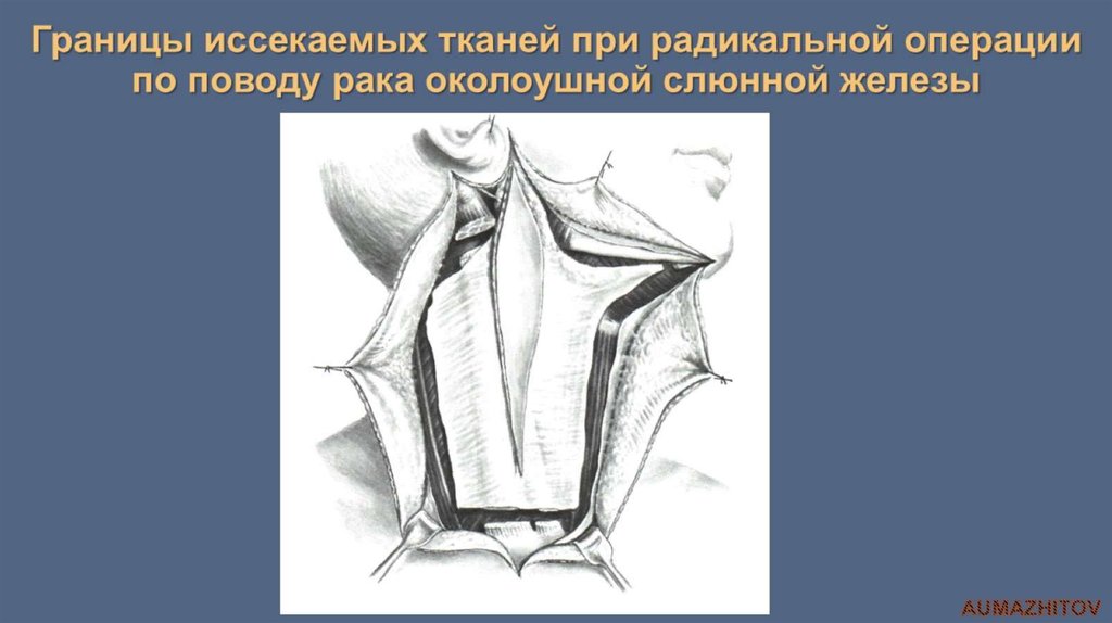 Границы иссекаемых тканей при радикальной операции по поводу рака околоушной слюнной железы