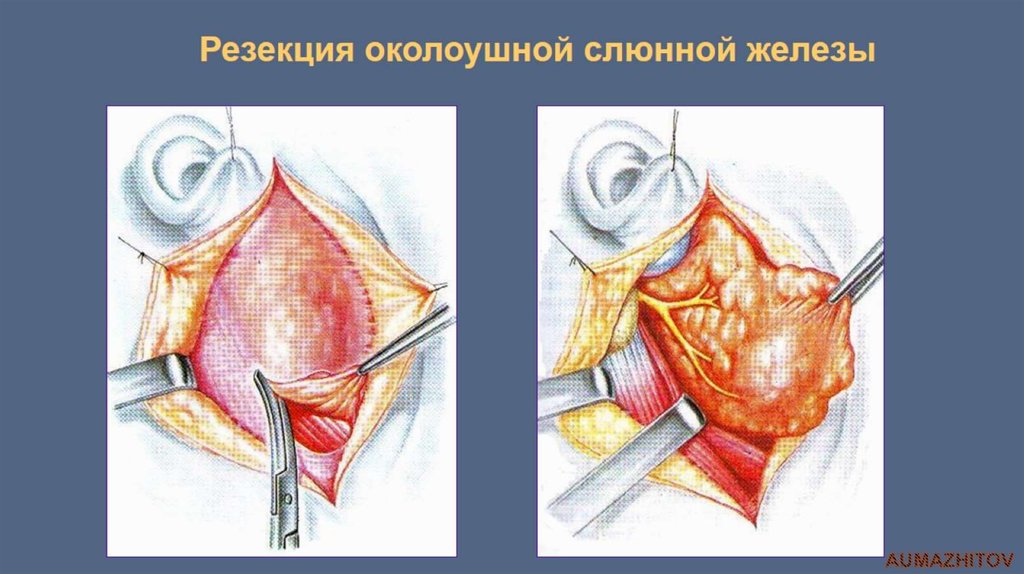 Резекция околоушной слюнной железы