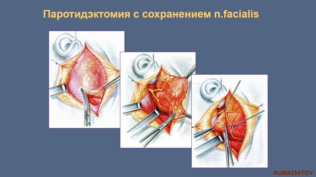 Паротидэктомия с сохранением n.facialis