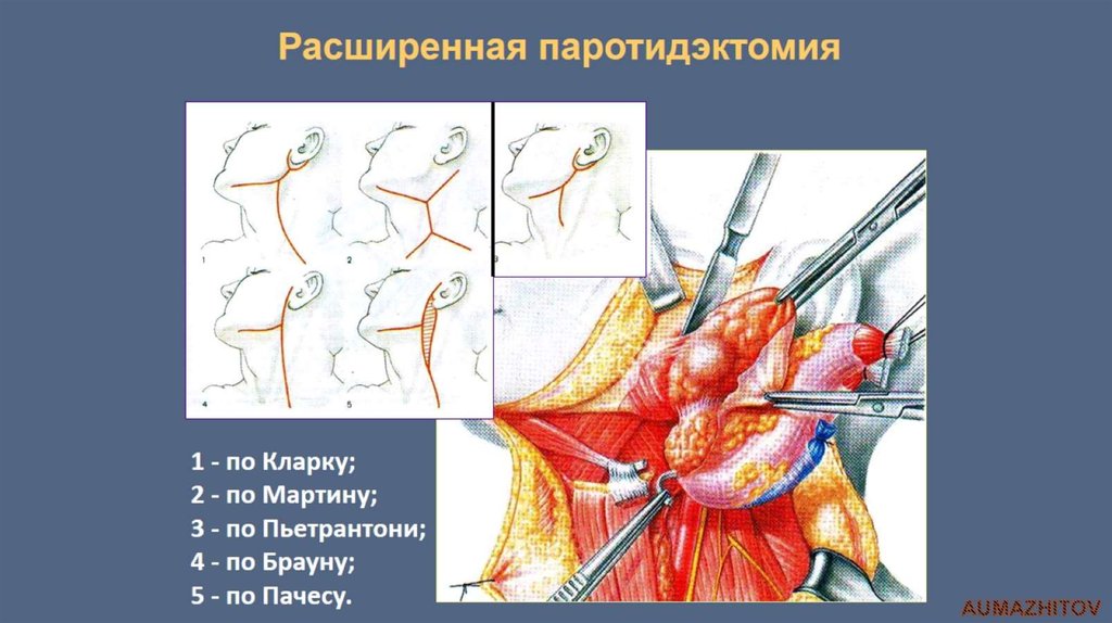 Расширенная паротидэктомия