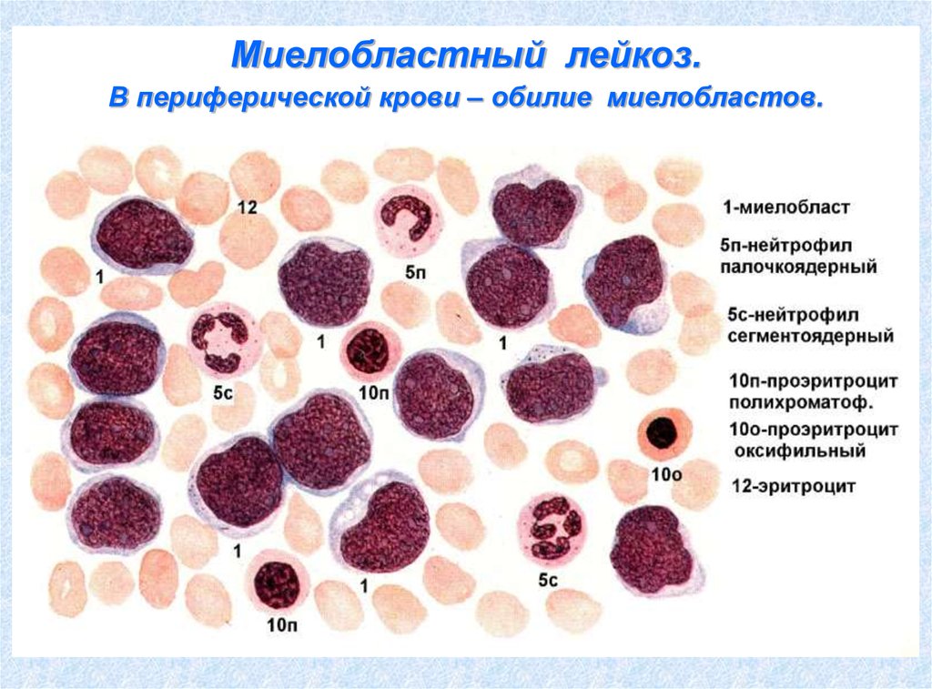 Лейкоз характеризуется. Острый миелобластный лейкоз картина крови патофизиология. Острый миелобластный лейкоз гистология. Острый миелобластный лейкоз картина крови этиология патогенез. Хронический миелоидный лейкоз картина крови.