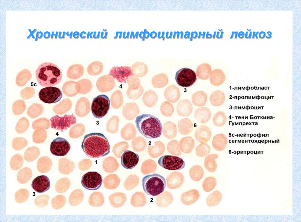 Злокачественные новообразования лимфоидной кроветворной ткани. Тени Боткина Гумпрехта. Тени Боткина Гумпрехта мазок крови. Клетки Боткина Гумпрехта это. Хронический лимфолейкоз клетки Боткина.