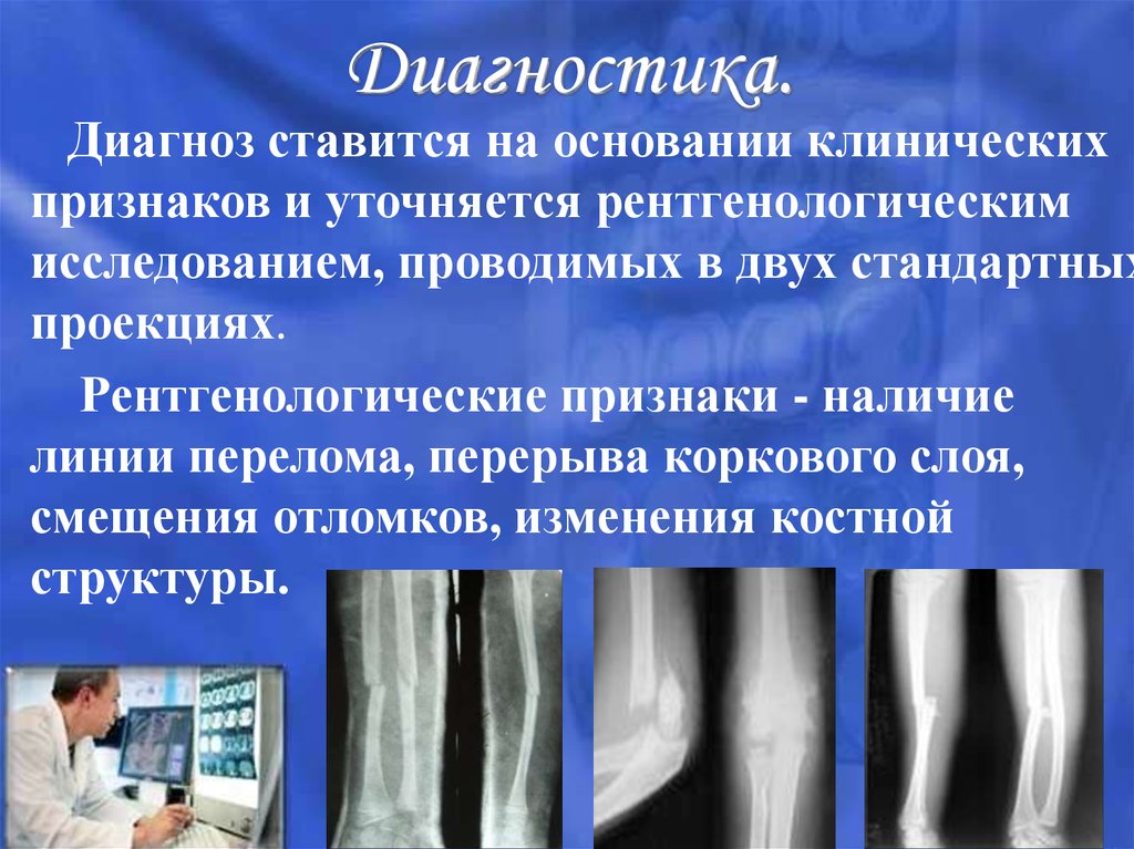 Диагноз трещина. Рентгенологические симптомы перелома кости. Рентгенологические симптомы перелома костей. Методыдипгностики переломов.