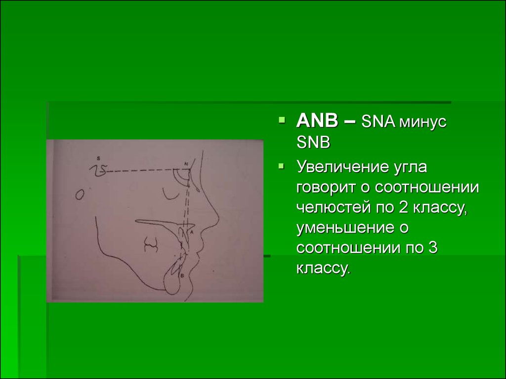 Уменьшенный угол. Угол sna на ТРГ. Sna SNB ANB углы. Угол ANB. Угол ANB В ортодонтии.