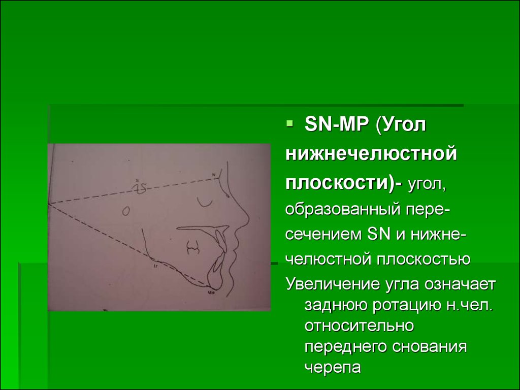 Углы на плоскости. Угол MP. Угол SPP MP. Угол SPP MP ортодонтия.