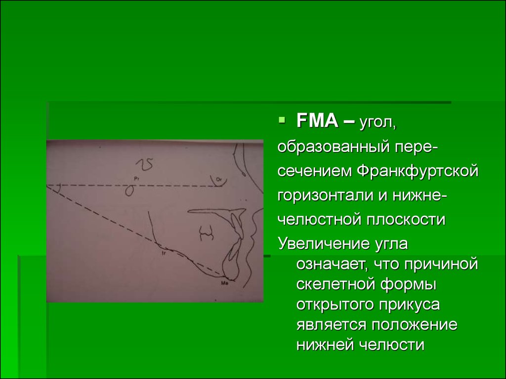 Увеличение угла. Франкфуртская горизонталь. Плоскость кампера франкфуртская горизонтальная плоскость. Франкфуртская горизонтальная плоскость стоматология. Крамфурская горизонталь.