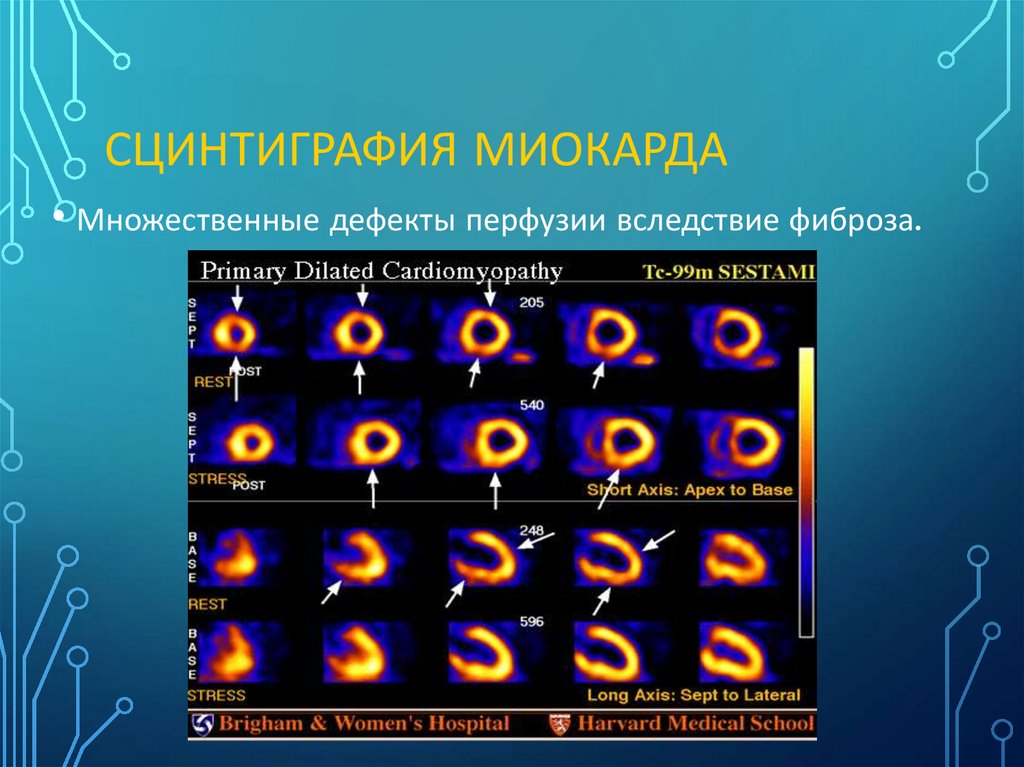 Сцинтиграфия миокарда. Сцинтиграфия дефект перфузии. Сцинтиграфия аппарат. Стресс-сцинтиграфии миокарда снимки. Сцинтиграфия снижение перфузии.