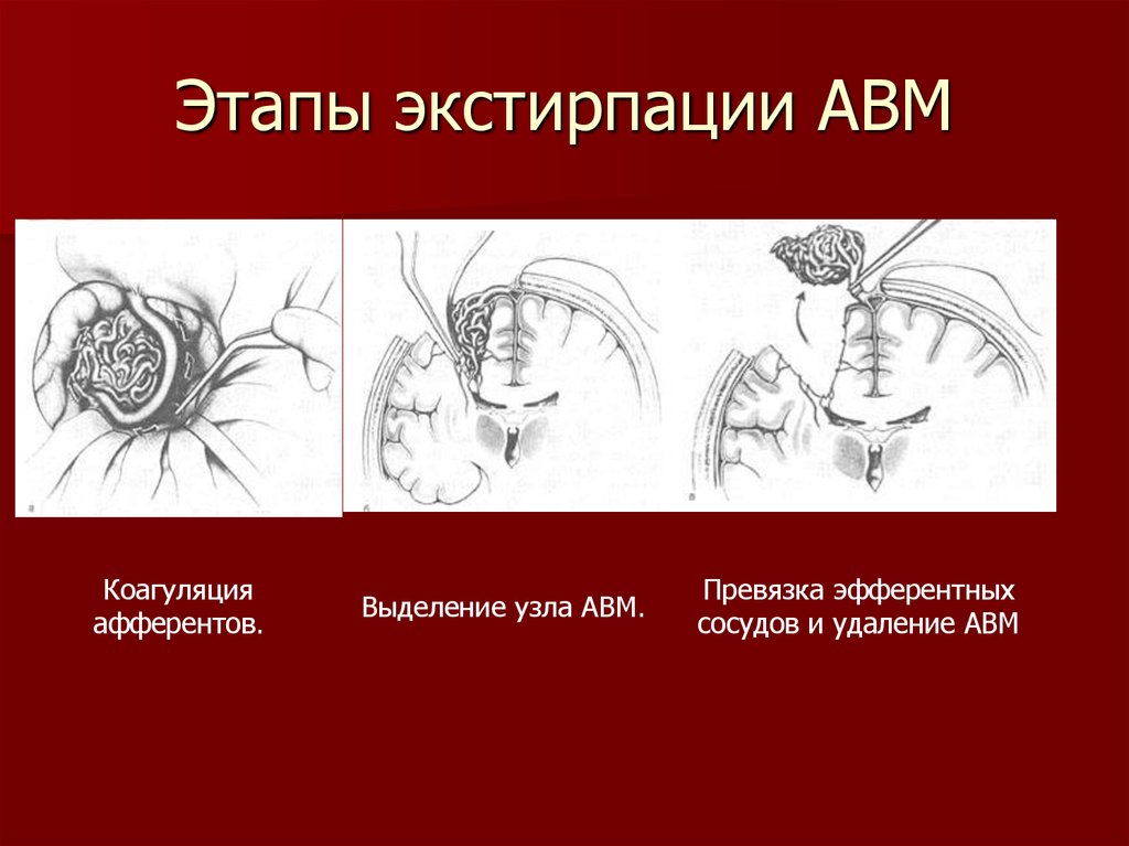 Экстирпация. Экстирпация головного мозга. Этапы АВМ.