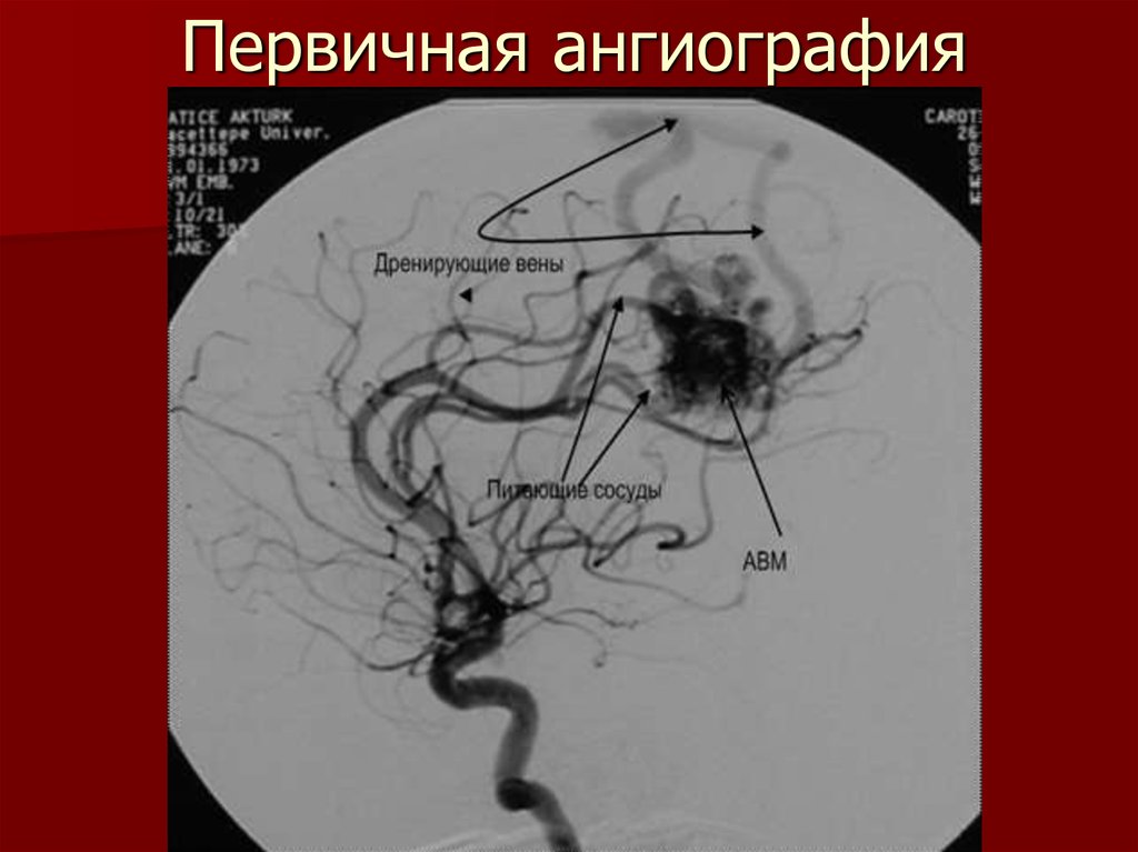 Сосудистая аномалия. Эмболизация АВМ сосудов головного мозга. Мальформация селезеночной артерии. Артериовенозная мальформация ангиография. Артерия венозная мальформация.