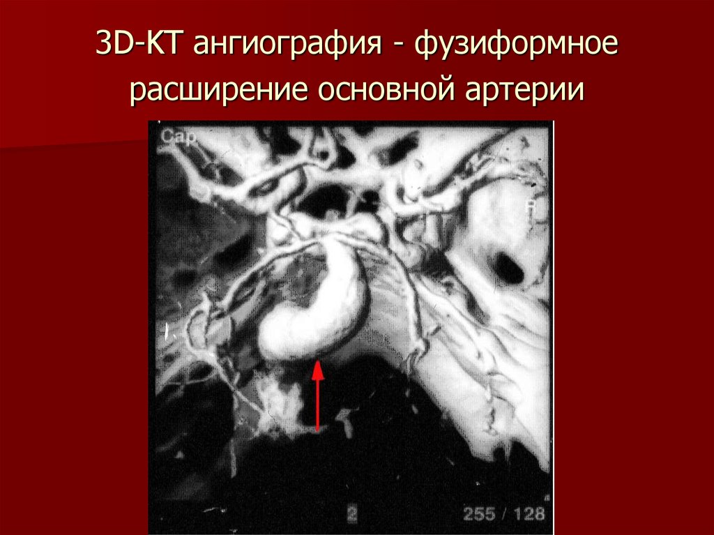 Аневризма сонной артерии симптомы