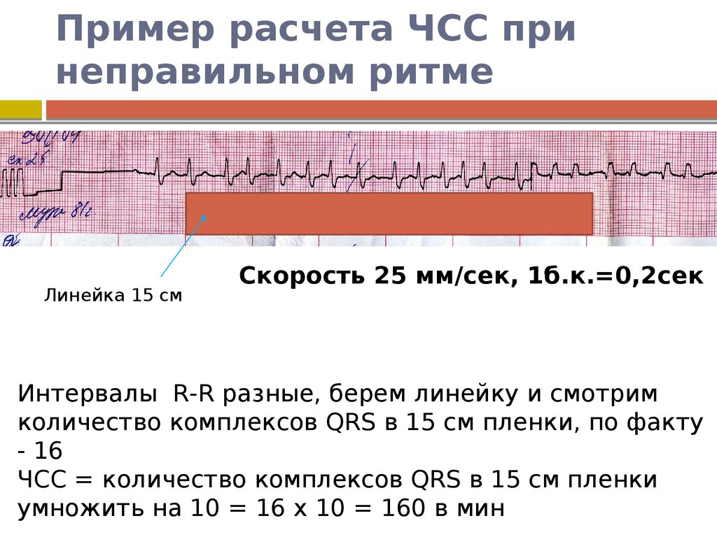 Как измерить частоту сердечных. Как определить ЧСС на ЭКГ при неправильном ритме. Как определить ЧСС по ЭКГ 25 мм. Формула ЧСС по ЭКГ 25 мм. Подсчет ЧСС при неправильном ритме по ЭКГ.