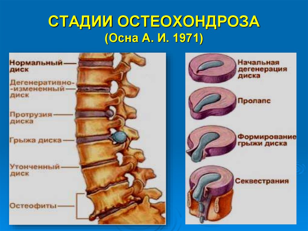 Остеохондроз поясничного отдела 1 периода. Межпозвонковый остеохондроз 2 стадия. Остеохондроз 1-2 степени грудного отдела. Этапы развития остеохондроза позвоночника. Остеохондроз 2 степени поясничного отдела позвоночника.