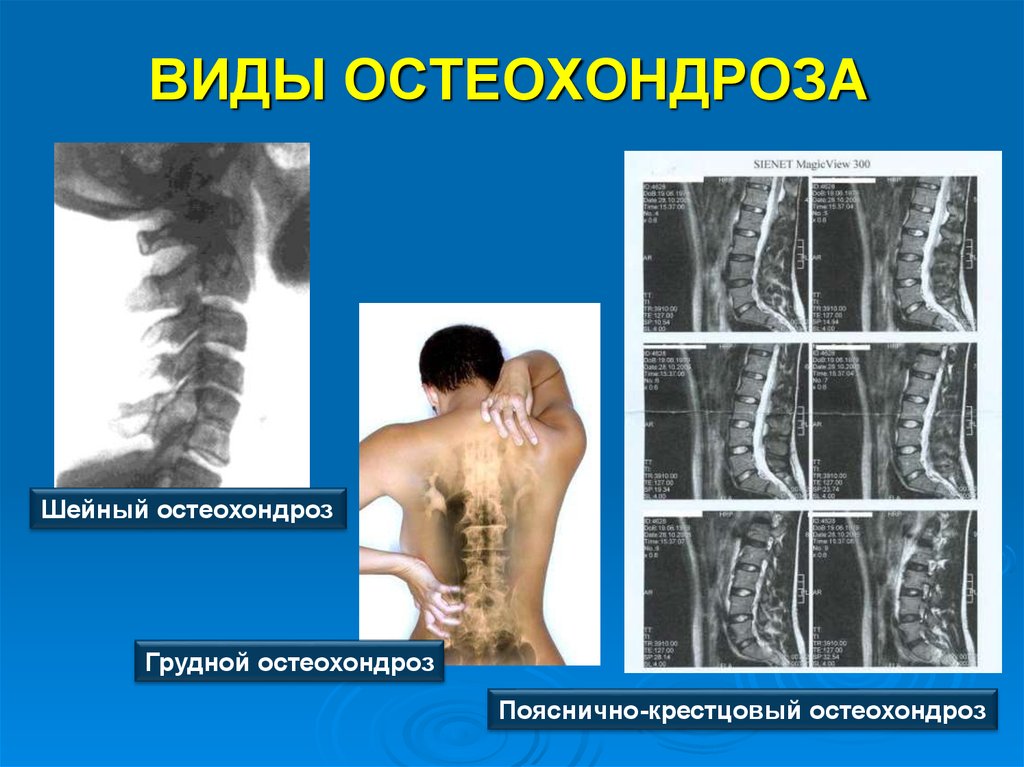 Остеохондроз шейный грудной поясничный. Виды остеохондроза. Клиника грудного остеохондроза. Остеохондроз грудного отдела клиника. Виды остеохондроза позвоночника.