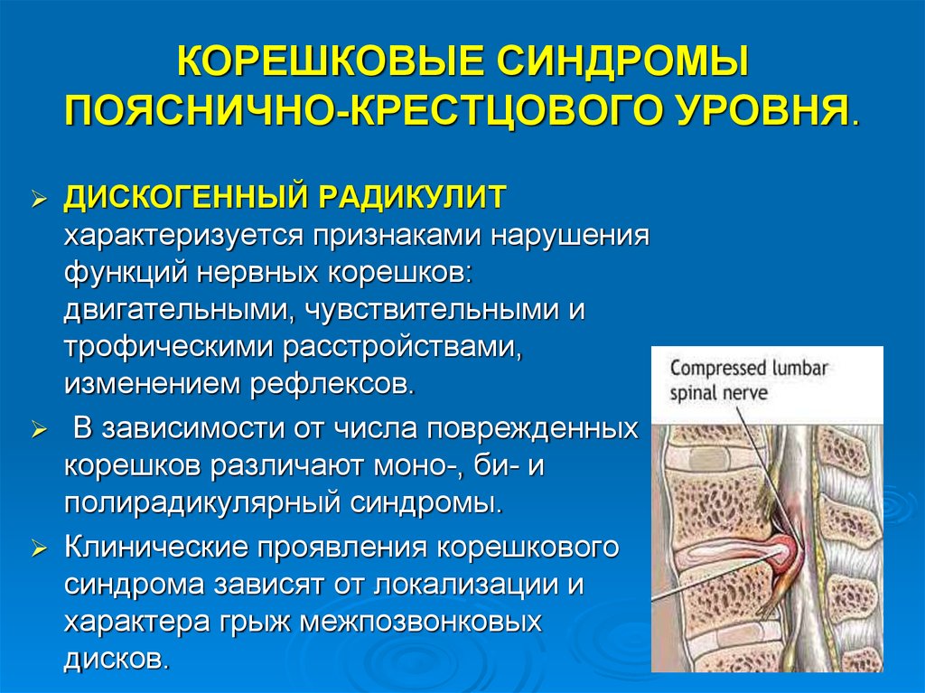 Пояснично крестцовая радикулопатия