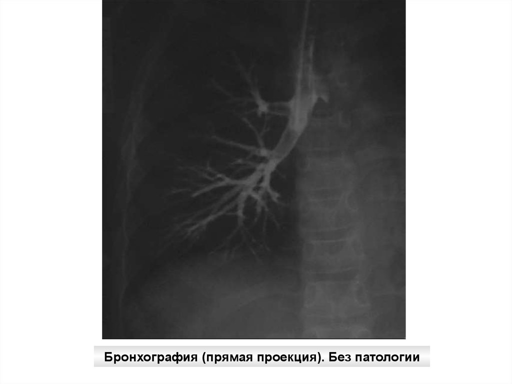 Без патологии. Бронхография патология. Бронхография при бронхите. Бронхография (боковая проекция). Без патологии.