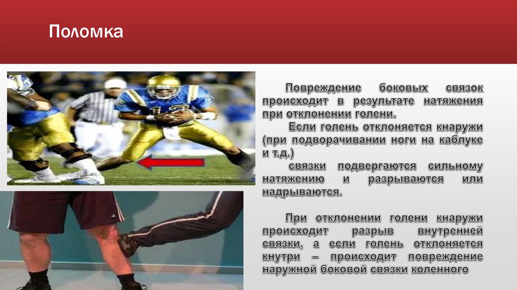 Разрыв капсульно связочного аппарата. Повреждение капсульного аппарата. Травма капсульно-связочного аппарата коленного сустава. Повреждение капсульного связанного аппарата. Частичное повреждение капсульно-связочного аппарата.
