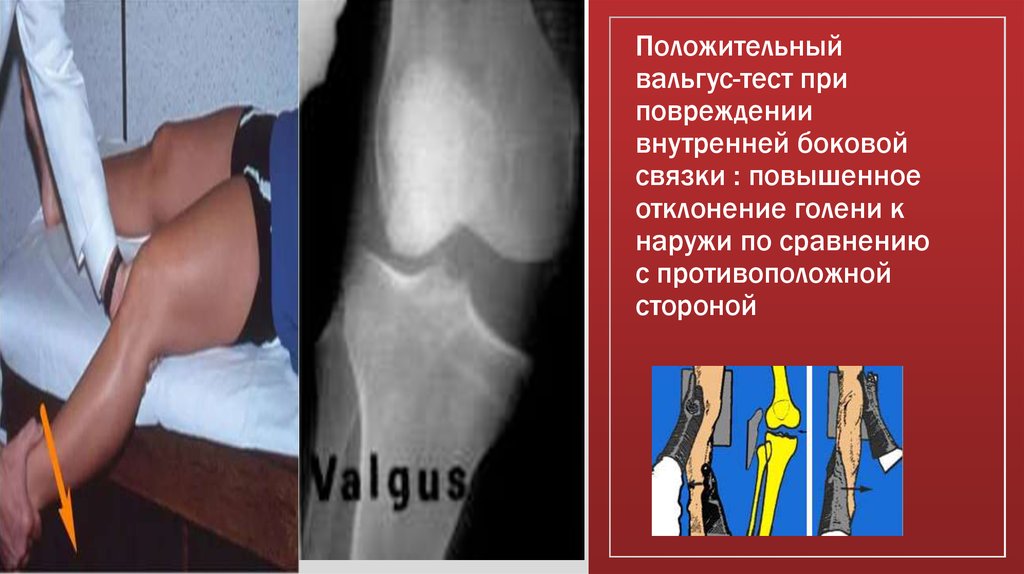 Положительный вальгус-тест при повреждении внутренней боковой связки : повышенное отклонение голени к наружи по сравнению с