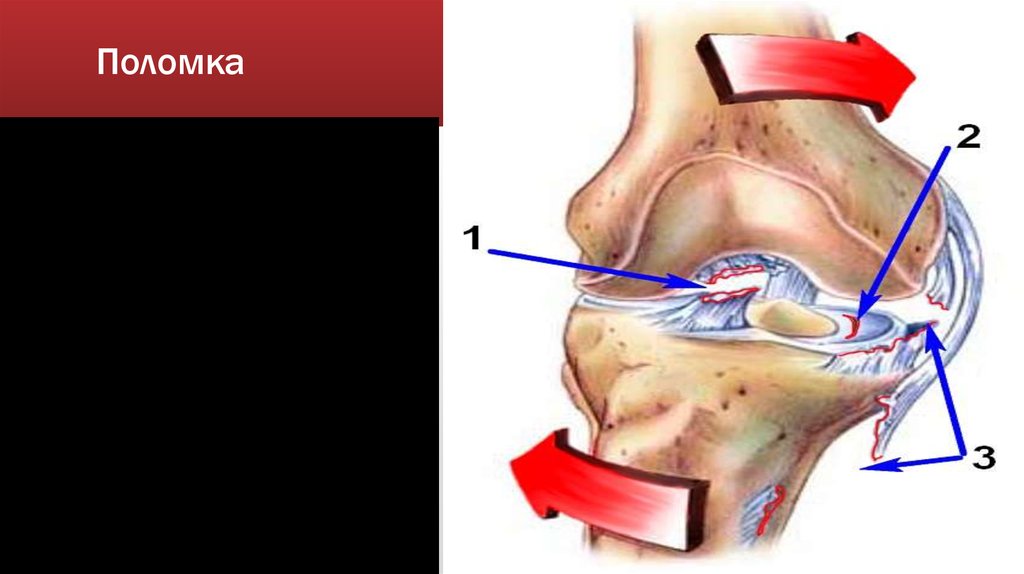 Повреждение капсульного связанного аппарата. Перенапряжение капсульно связочного аппарата. Повреждение капсульного связанного аппарата. Разрыв капсульно связочного аппарата. Связочный аппарат коленного сустава анатомия.
