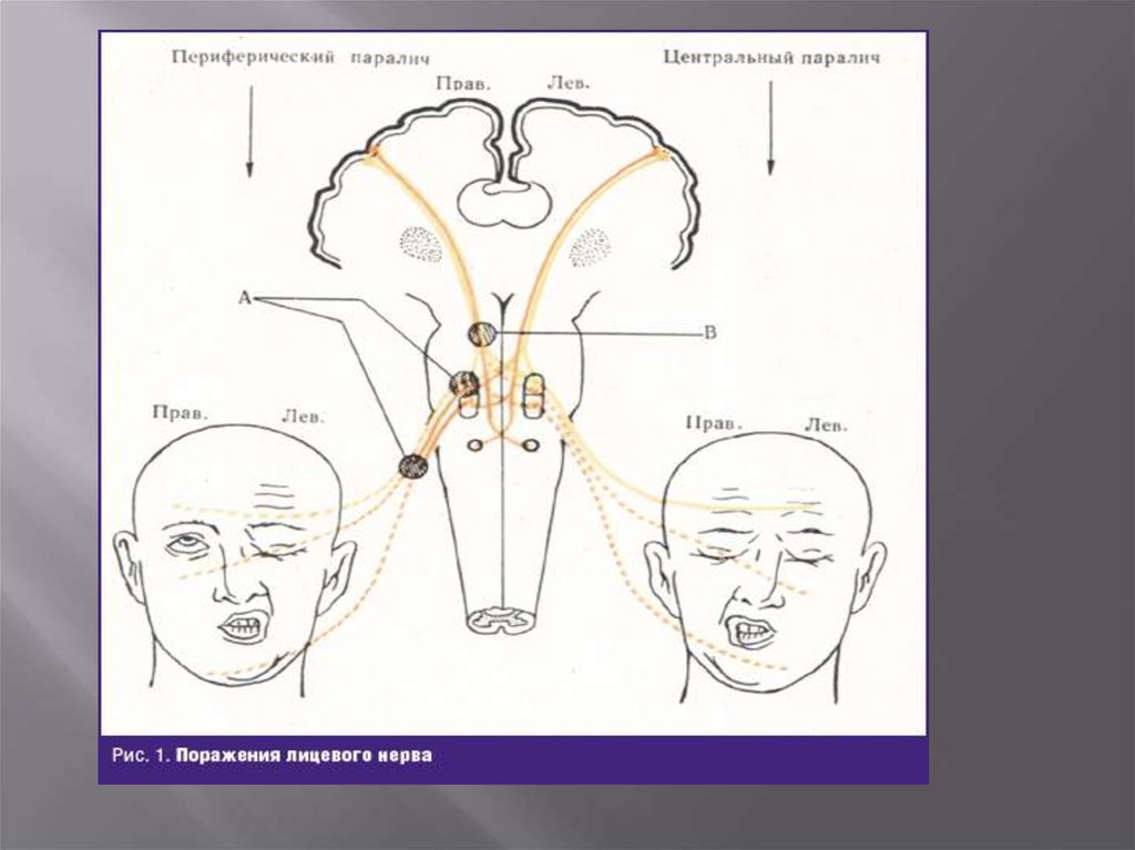 Симптомы поражения лицевого нерва