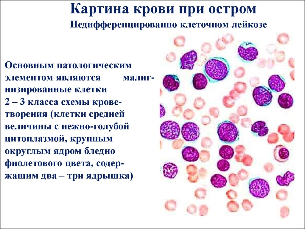 Изменение клеток крови. Хронический миелоидный лейкоз картина крови. Острый лейкоз мазок крови. Острый миелоидный лейкоз картина крови. Острый миелобластный лейуозкартина крови.
